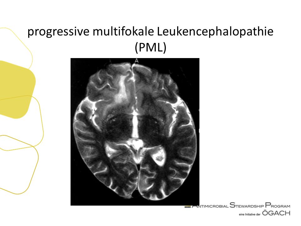 progressive multifokale Leukencephalopathie (PML)