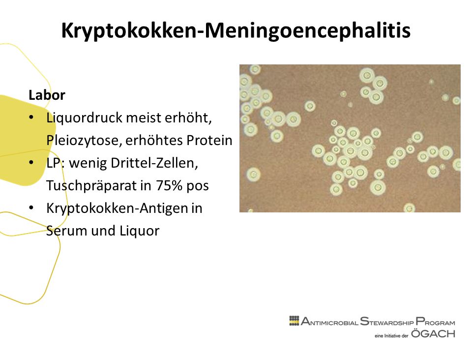 Kryptokokken-Meningoencephalitis Labor Liquordruck meist erhöht, Pleiozytose, erhöhtes Protein LP: wenig Drittel-Zellen, Tuschpräparat in 75% pos Kryptokokken-Antigen in Serum und Liquor