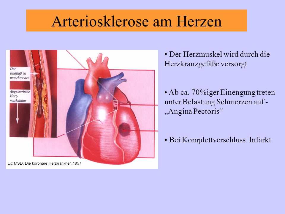 Arteriosklerose am Herzen Der Herzmuskel wird durch die Herzkranzgefäße versorgt Ab ca.