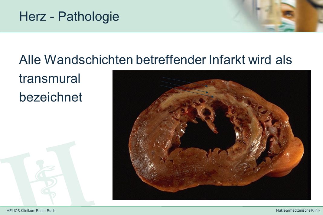 HELIOS Klinikum Berlin-Buch Nuklearmedizinische Klinik Herz - Pathologie Abheilung als Infarktnarbe