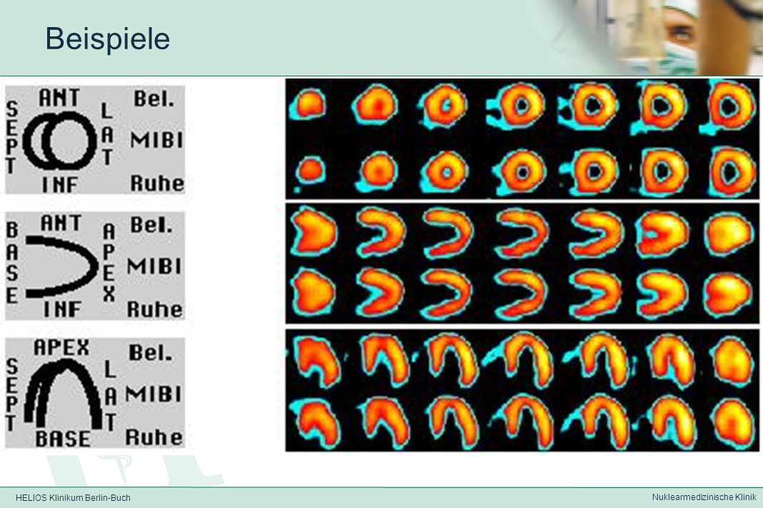HELIOS Klinikum Berlin-Buch Nuklearmedizinische Klinik 99m Tc-MIBI-Myokardszintigraphie Bulls-eye-Analyse