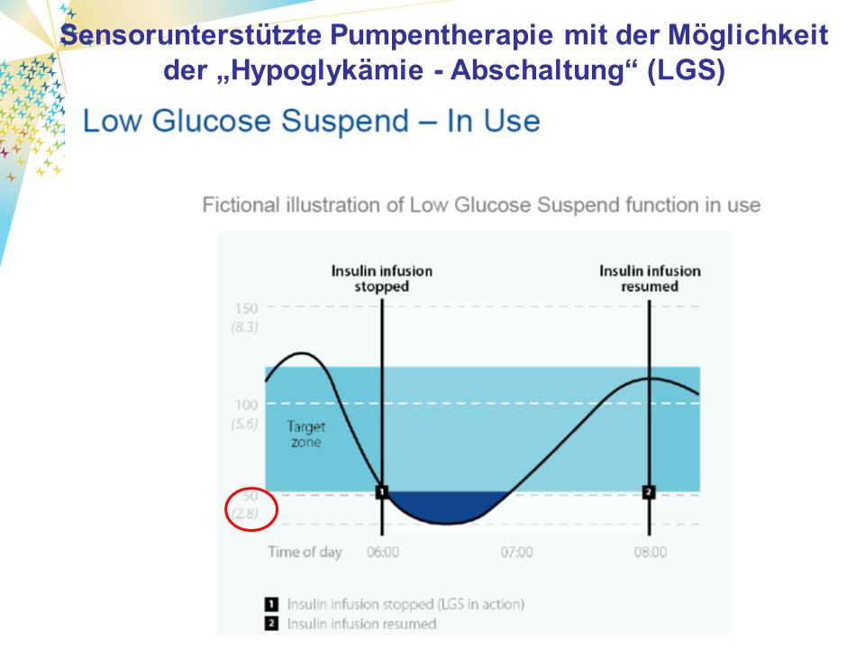 Sensorunterstützte Pumpentherapie mit der Möglichkeit der Hypoglykämie - Abschaltung (LGS)