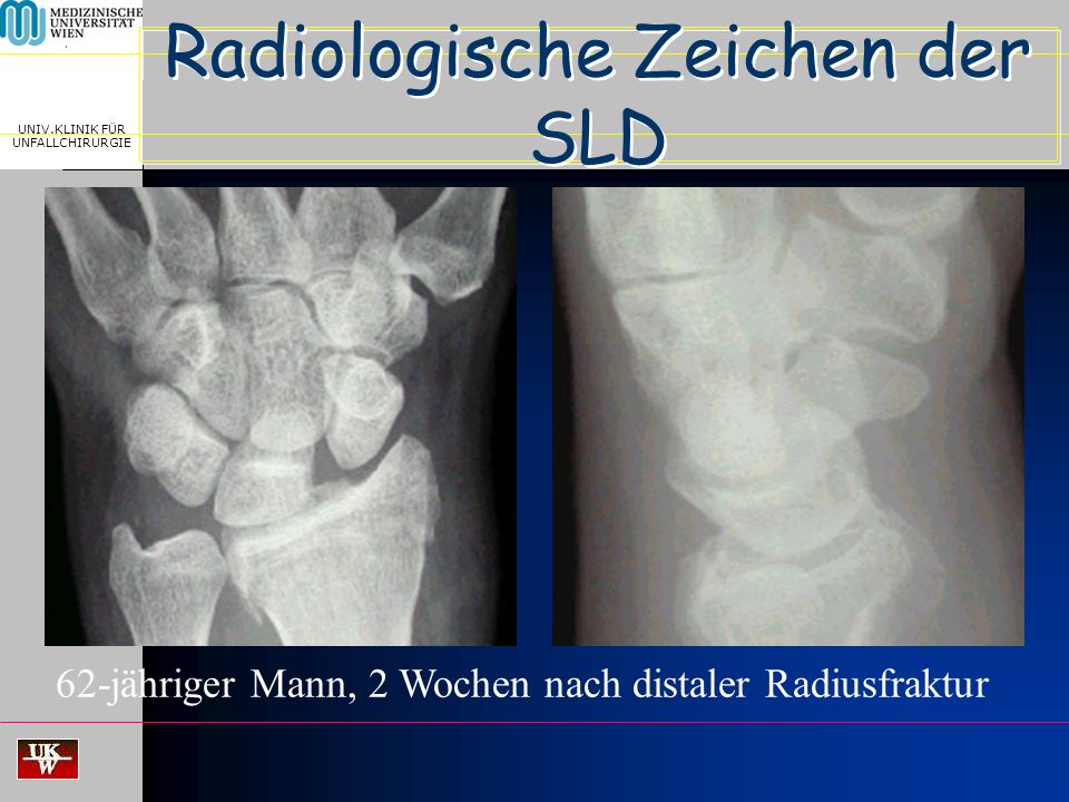 MEDICAL UNIVERSITY, VIENNA, AUSTRIA UNIV.KLINIK FÜR UNFALLCHIRURGIE Radiologische Zeichen der SLD > 2 mm < 7 mm ~ 90° 62-jähriger Mann, 2 Wochen nach distaler Radiusfraktur