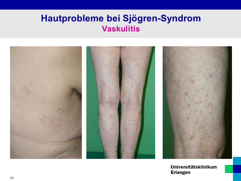 10 Hautprobleme bei Sjögren-Syndrom Vaskulitis