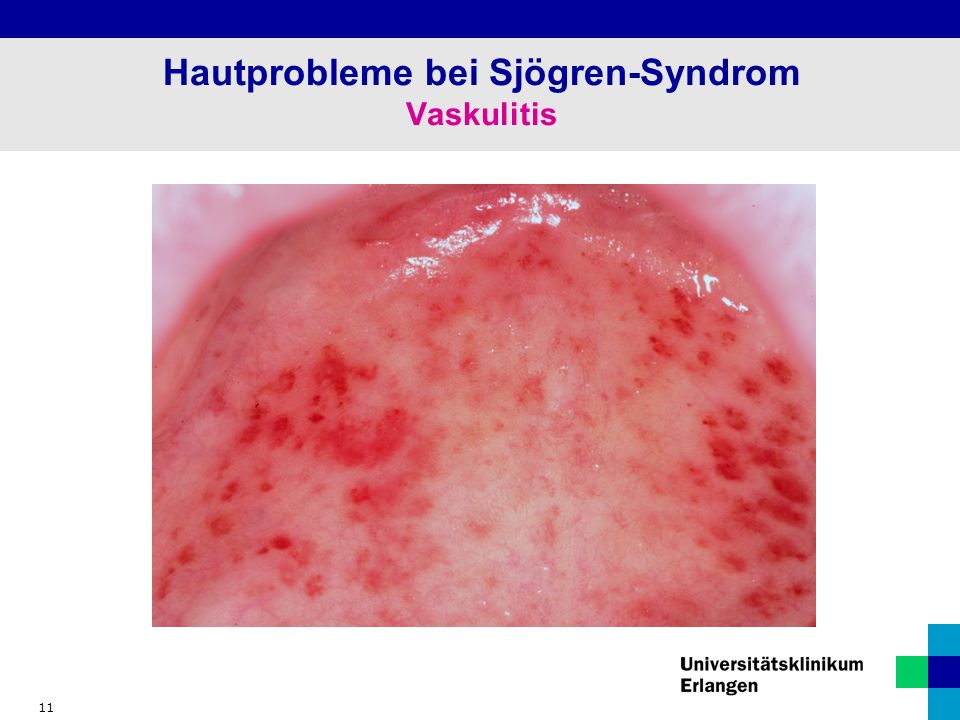 11 Hautprobleme bei Sjögren-Syndrom Vaskulitis
