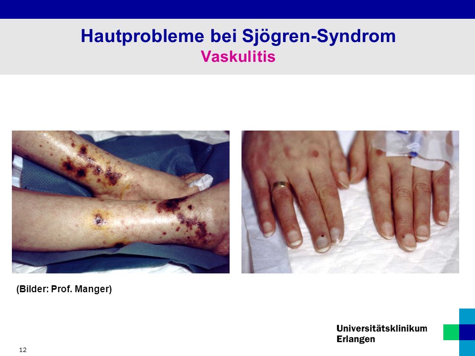 12 Hautprobleme bei Sjögren-Syndrom Vaskulitis (Bilder: Prof. Manger)