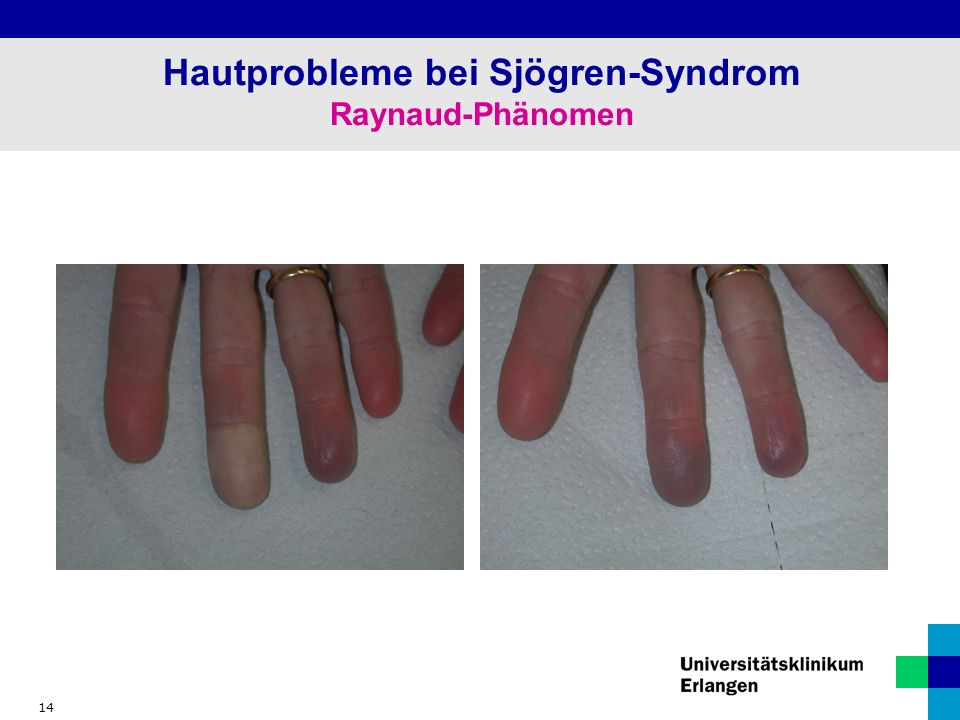 14 Hautprobleme bei Sjögren-Syndrom Raynaud-Phänomen