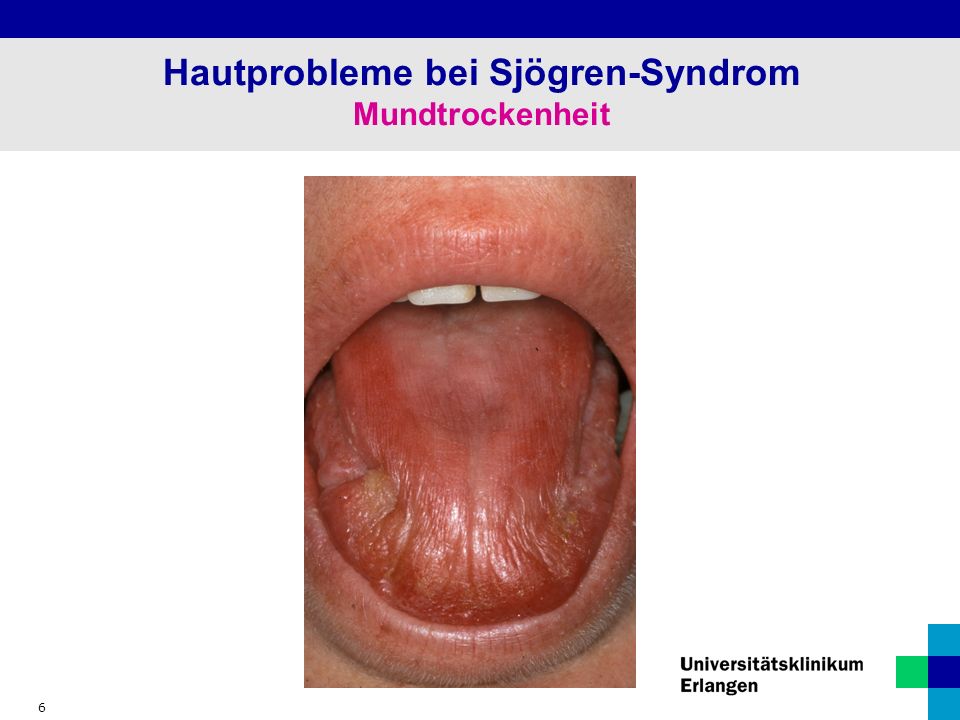 6 Hautprobleme bei Sjögren-Syndrom Mundtrockenheit
