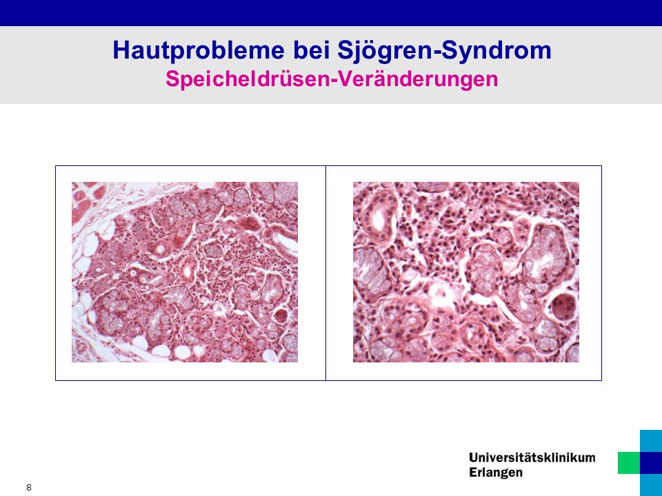 8 Hautprobleme bei Sjögren-Syndrom Speicheldrüsen-Veränderungen