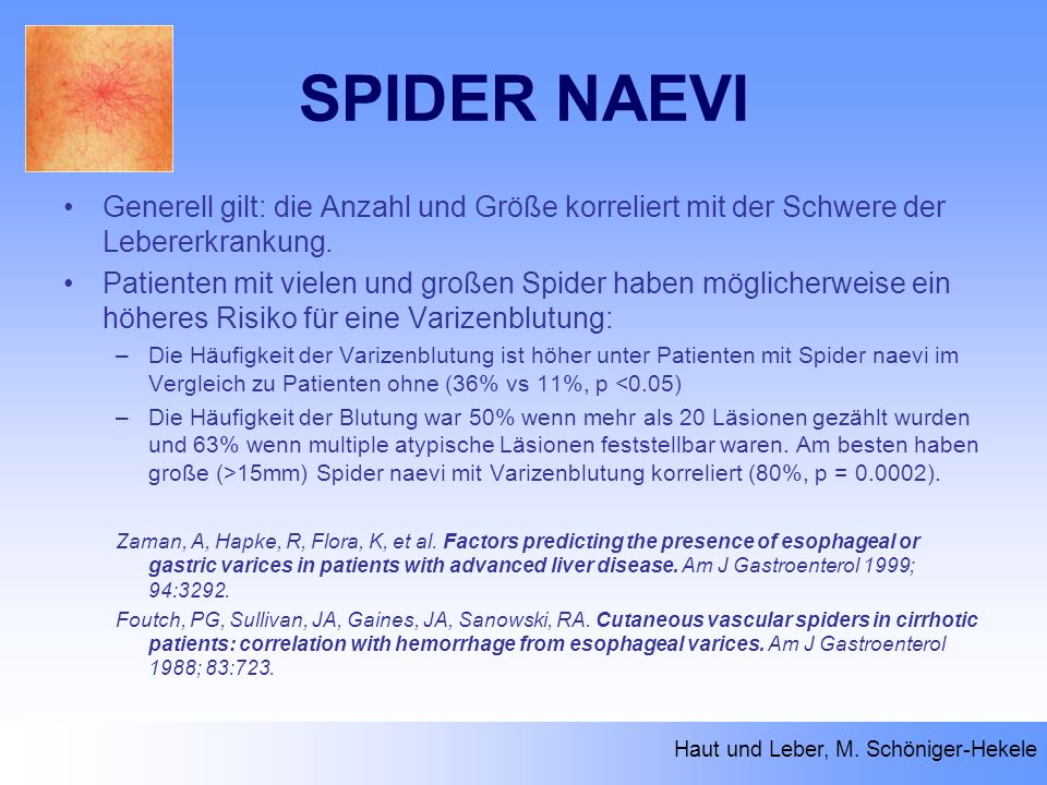SPIDER NAEVI Generell gilt: die Anzahl und Größe korreliert mit der Schwere der Lebererkrankung.