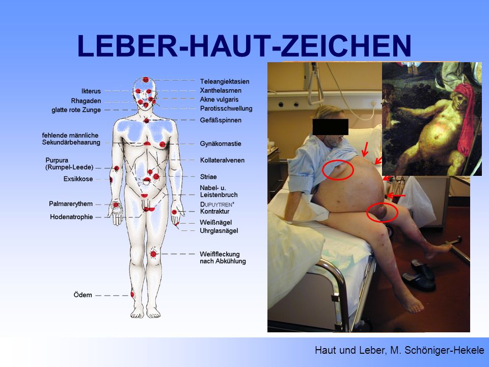 LEBER-HAUT-ZEICHEN Haut und Leber, M. Schöniger-Hekele