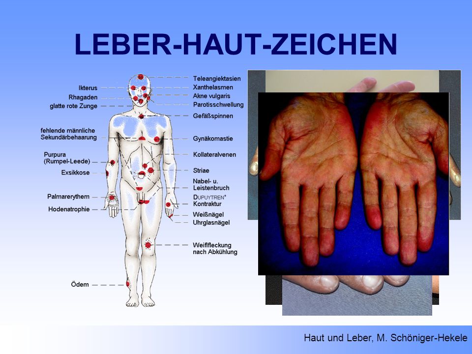 LEBER-HAUT-ZEICHEN Haut und Leber, M. Schöniger-Hekele