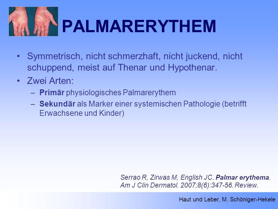 PALMARERYTHEM Haut und Leber, M. Schöniger-Hekele Serrao R, Zirwas M, English JC.