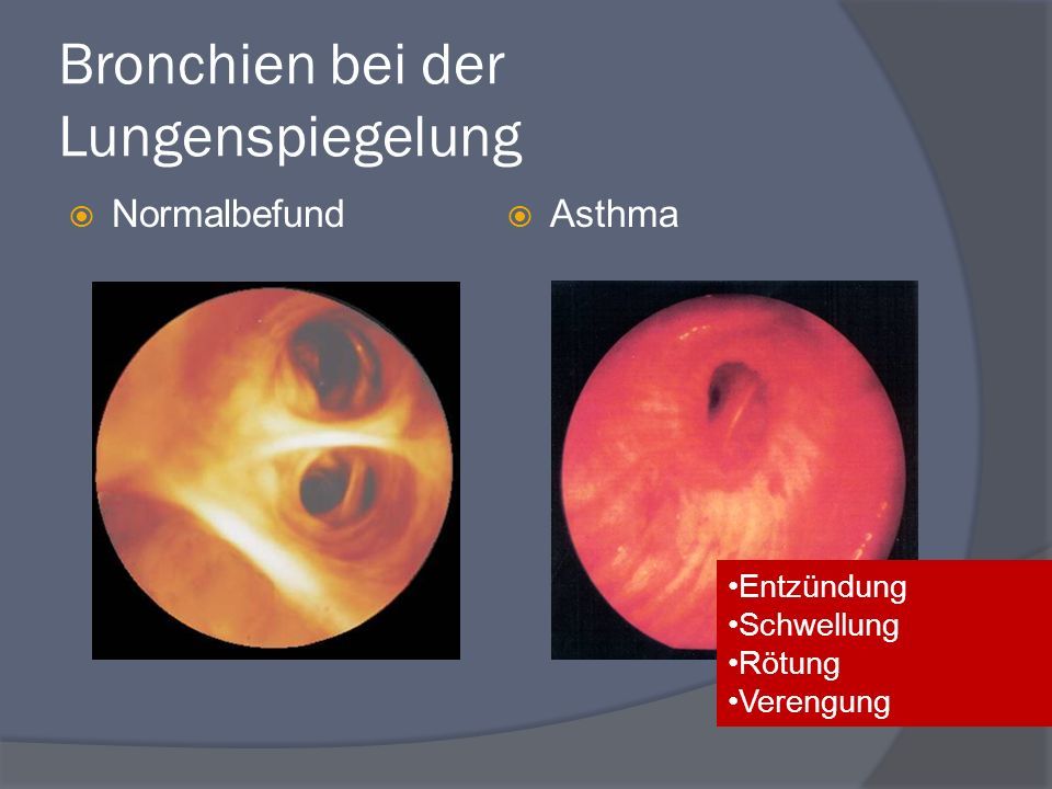 Bronchien bei der Lungenspiegelung  Normalbefund  Asthma Entzündung Schwellung Rötung Verengung